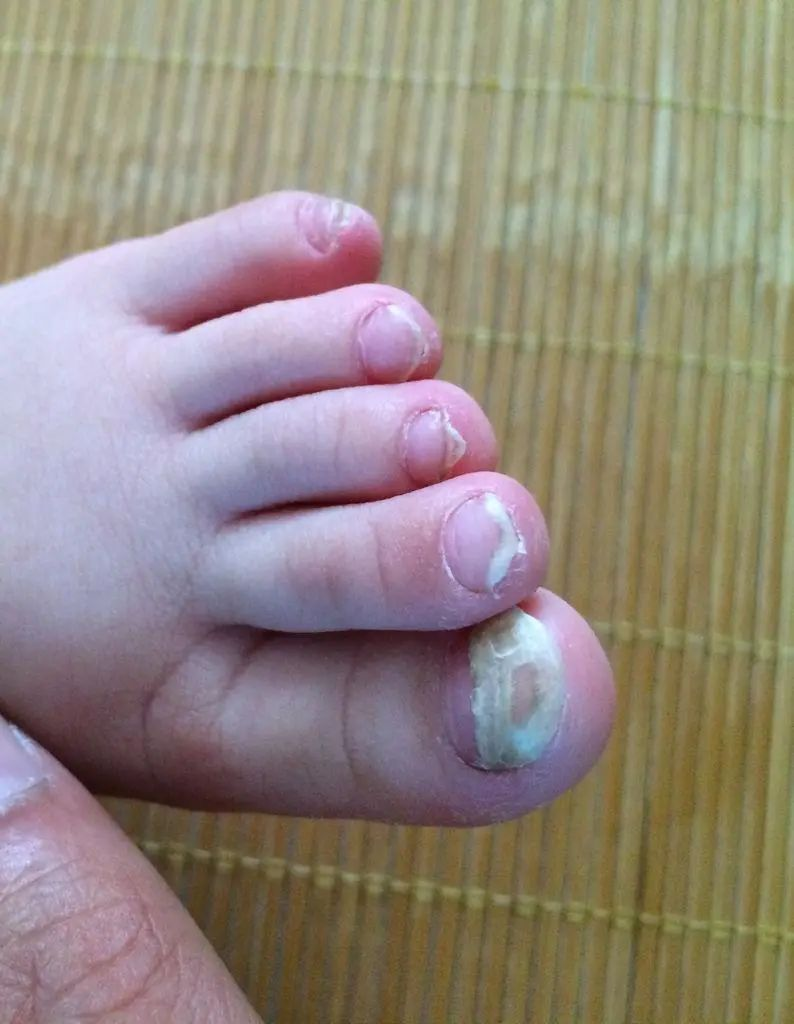 6,指甲性状异常宝宝的指甲一般是光滑的,如果突然发生改变,就要多注意