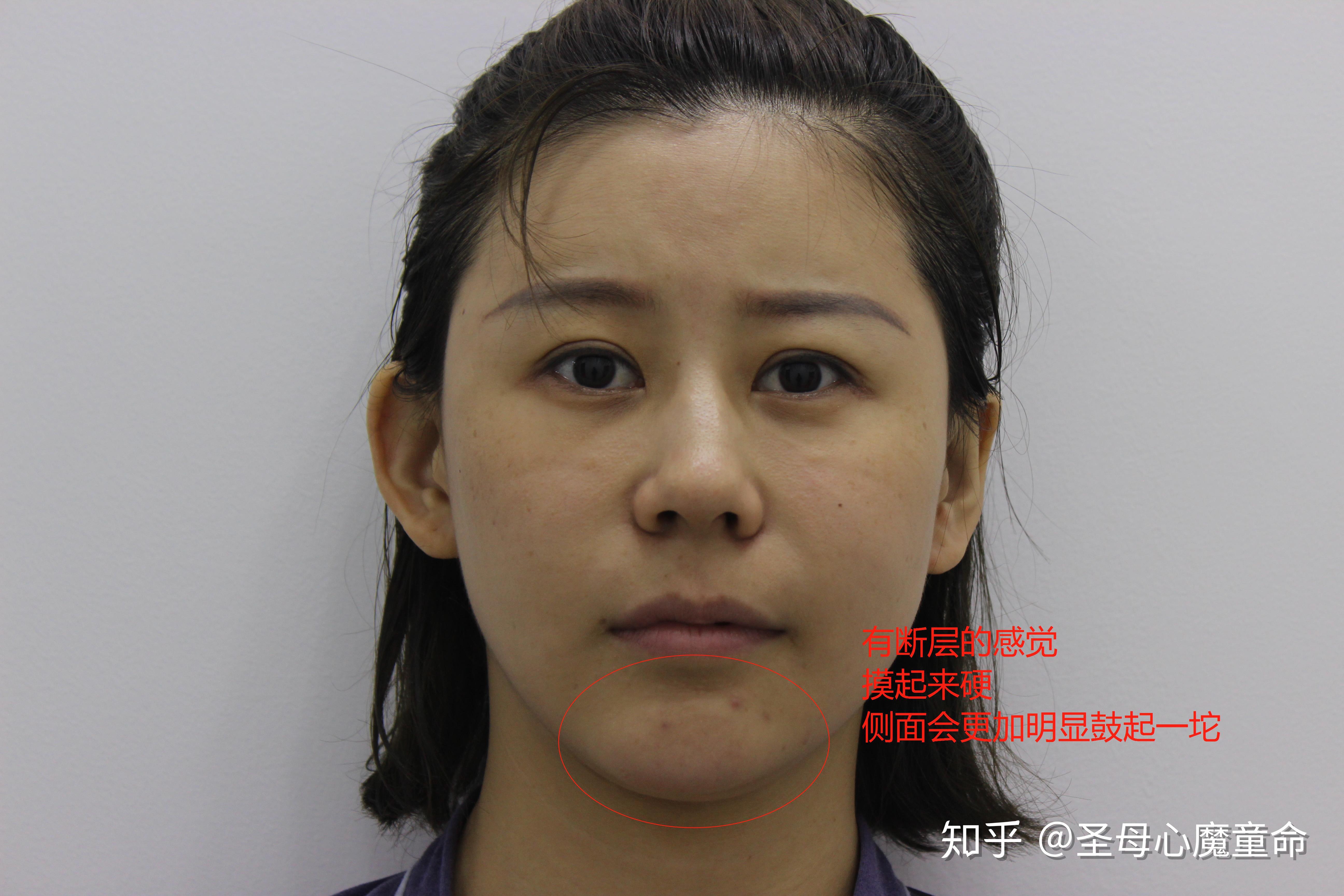 玻尿酸,下巴生长因子修复第10天