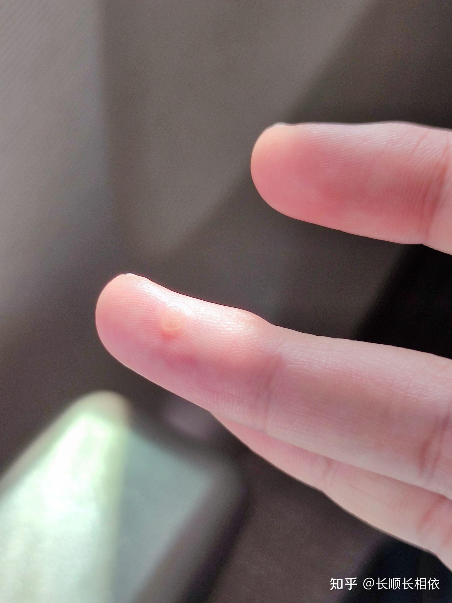 激光去除手指病毒疣记录