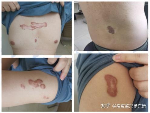 什么是疤痕体质