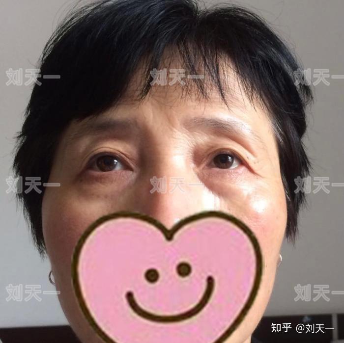 侧光下看到的问题更清晰严重的外眼角下垂(三角眼)可以遮挡2/3的视线