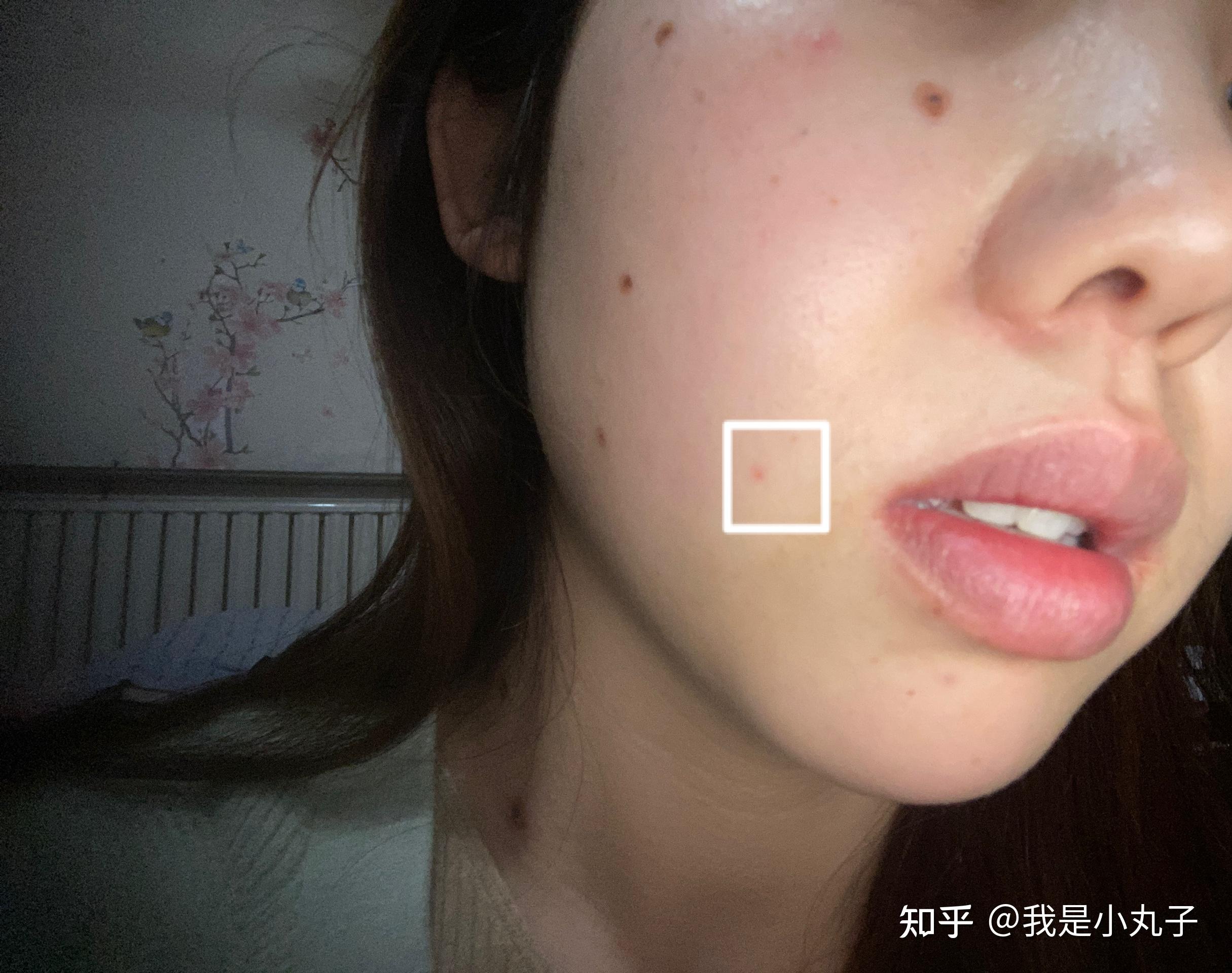 冷冻点痣的心理历程