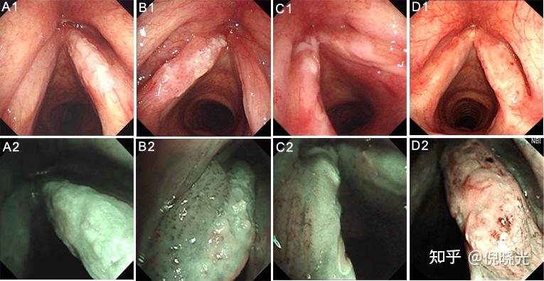 咽喉口腔真菌感染图片图片