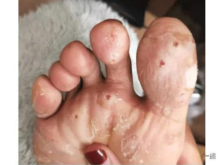 传染疣长势极其迅猛的跖疣回击战