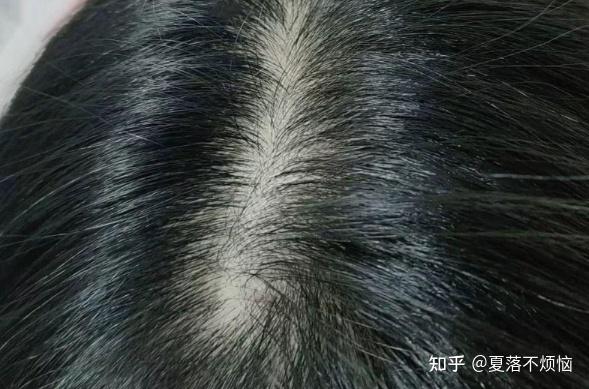 头油、头臭、头痒,头皮屑大块大块洗不干净,脂溢性皮炎如何自救?二硫化硒真的有用吗? - 知乎