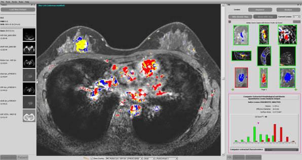 在臨床實驗中,quantx 被用於幫助放射科醫生查看 mri 並分辨乳腺癌及