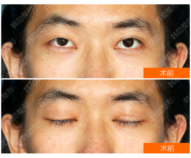 韩勋说双眼皮怎样才显得有精神