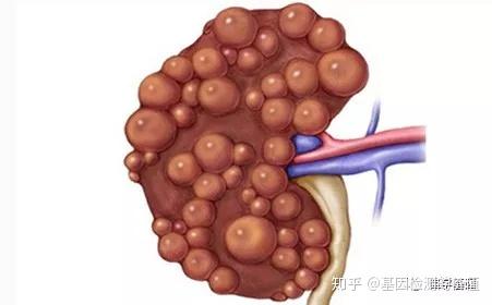 什么是基因突变病呢 v2-a5be0a85b1d7097f47afebfa71c0af76_r.jpg