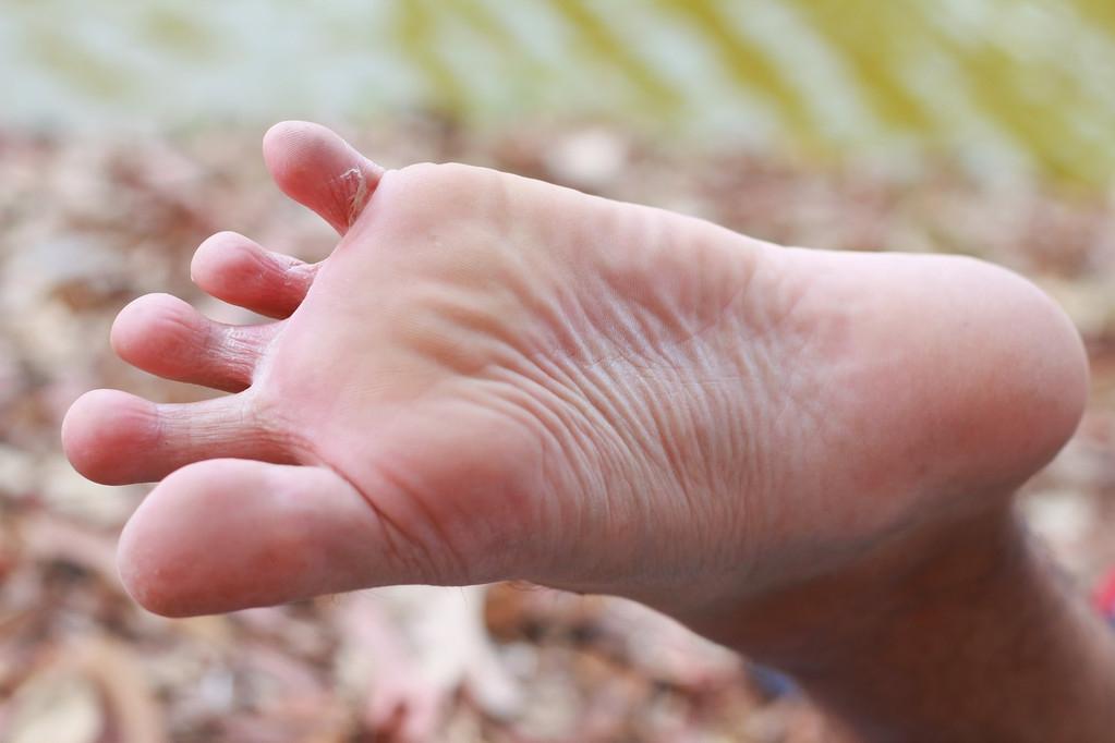 香港脚是什么(为什么脚气被称为香港脚呢)插图