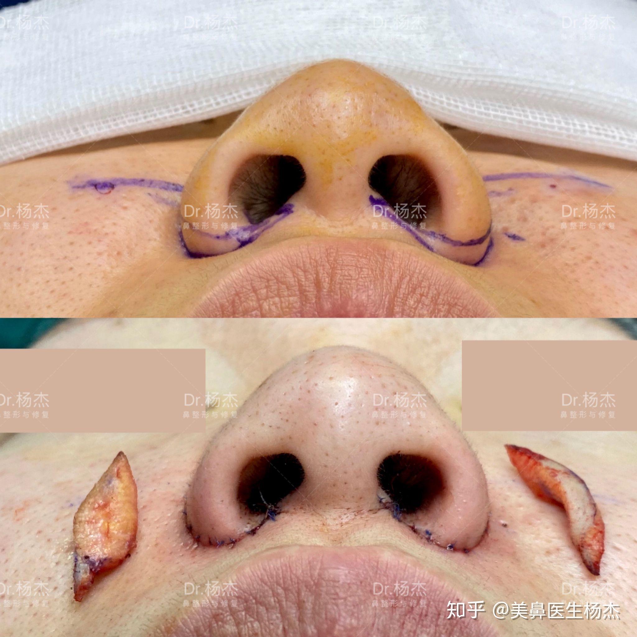 内外联合缩鼻翼