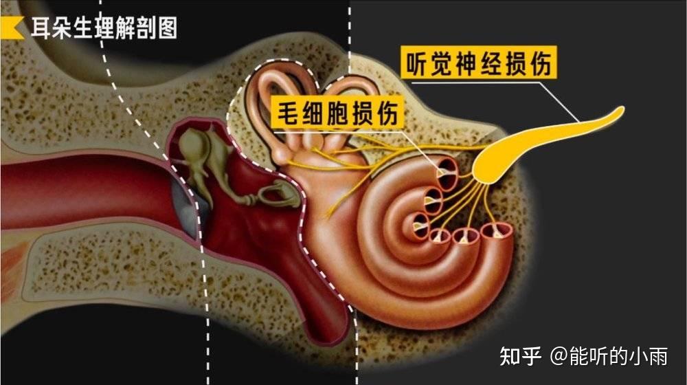 南川惠耳助听器分享:什么是感音神经性耳聋? - 知乎