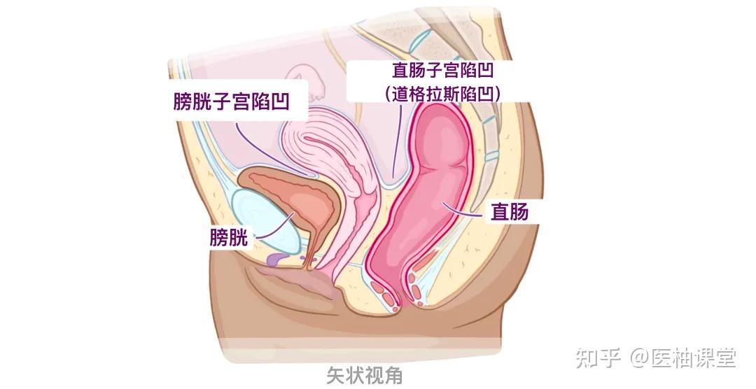 子宫直肠窝解剖图片