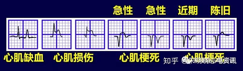 第十三講:st段改變與心肌缺血1 - 知乎