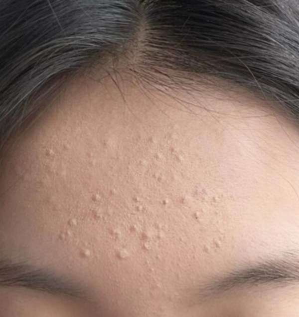 脸上80%的地方都长闭口粉刺,怎样快速去除?【皮肤科医生】手把手教你去闭口粉刺的方法,再顽固的闭口粉刺也能通通搞定! - 知乎