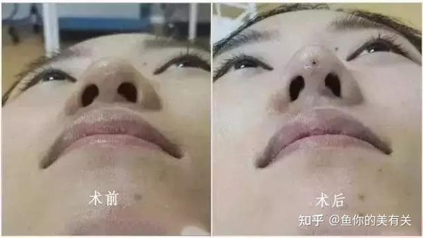 想要高挺美鼻?线雕隆鼻助你一“鼻”之力【善美宁隆鼻】 - 知乎