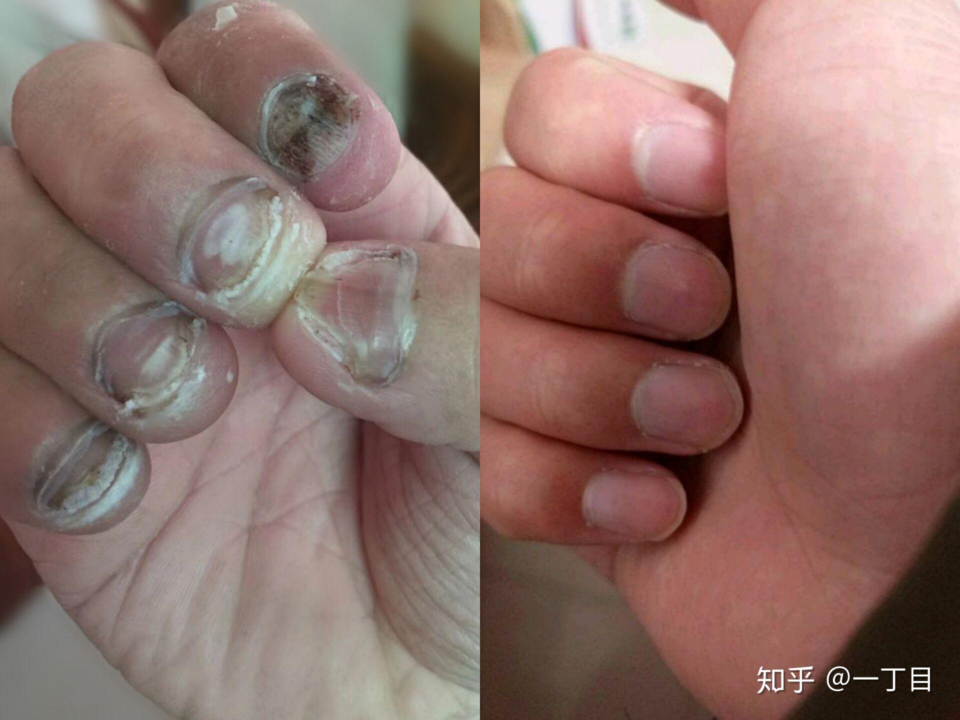 治疗灰指甲过程中需要注意什么