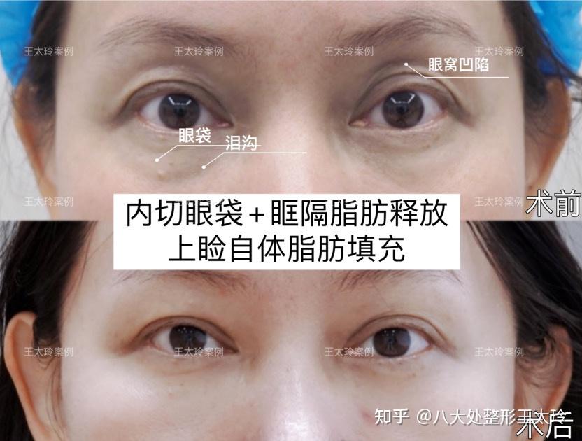 内切眼袋+眶隔脂肪释放+上睑自体脂肪填充案例分享 - 知乎