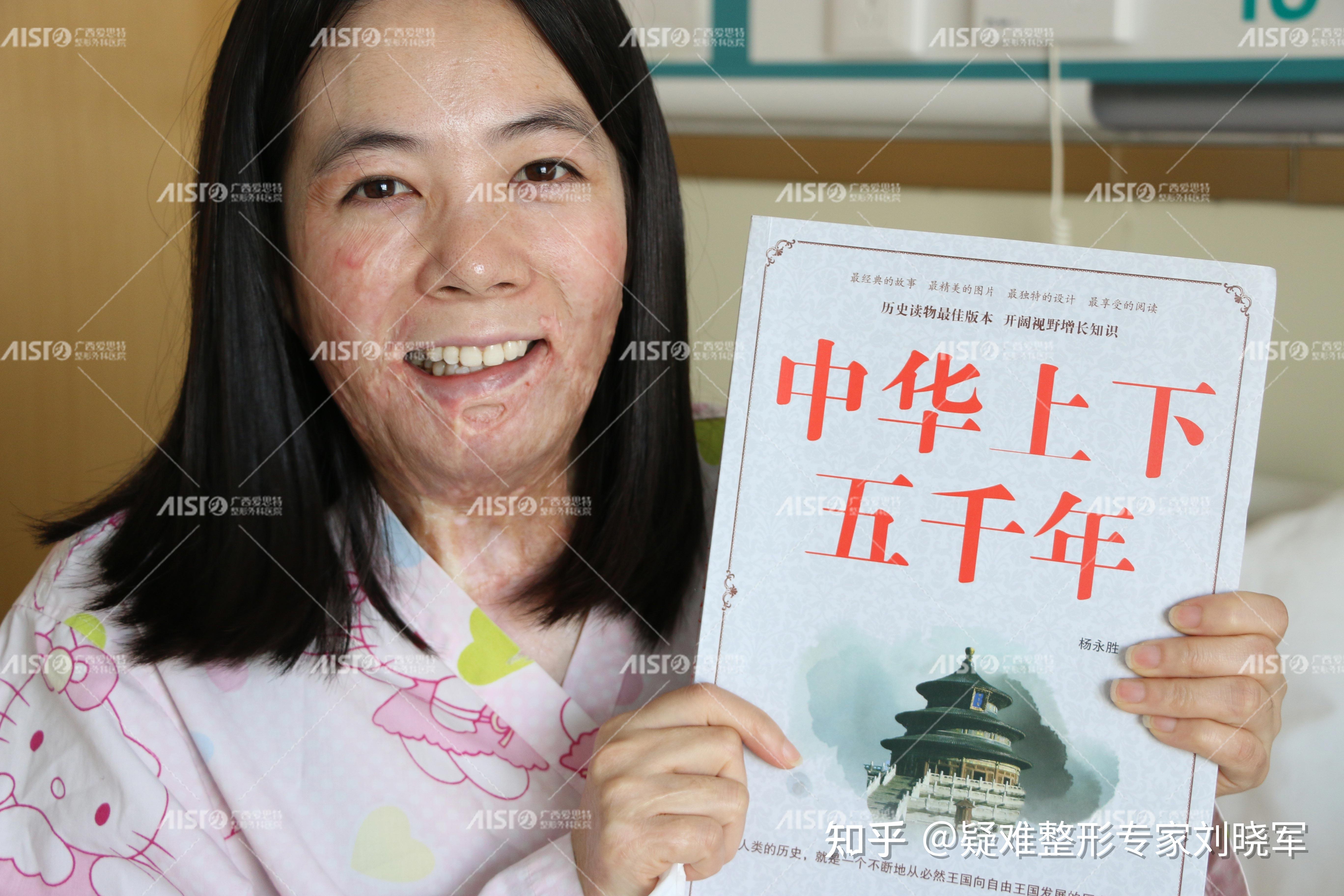 毁容女孩的4年祛疤之路:那些杀不死我的,终将使我强大! - 知乎