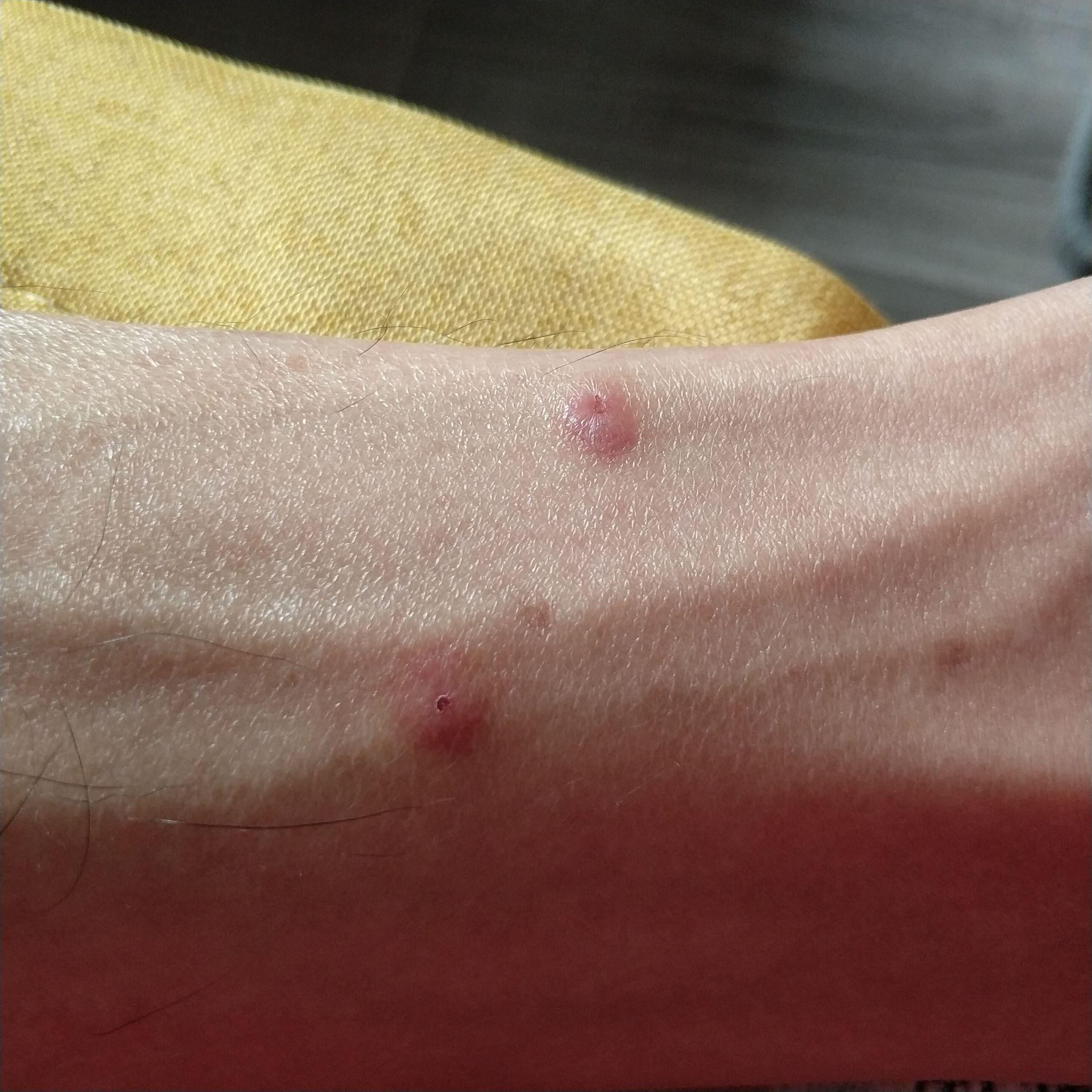 什么虫咬人是两个针眼大小的点