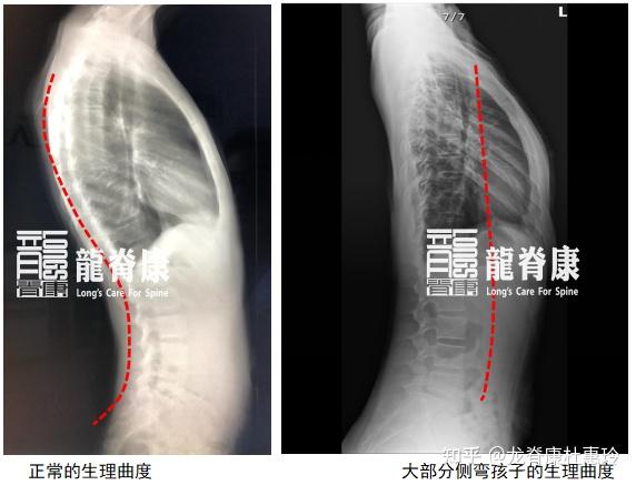 孩子脊柱侧弯,“平背”问题需警惕!2个动作练出脊柱健康曲度 - 知乎