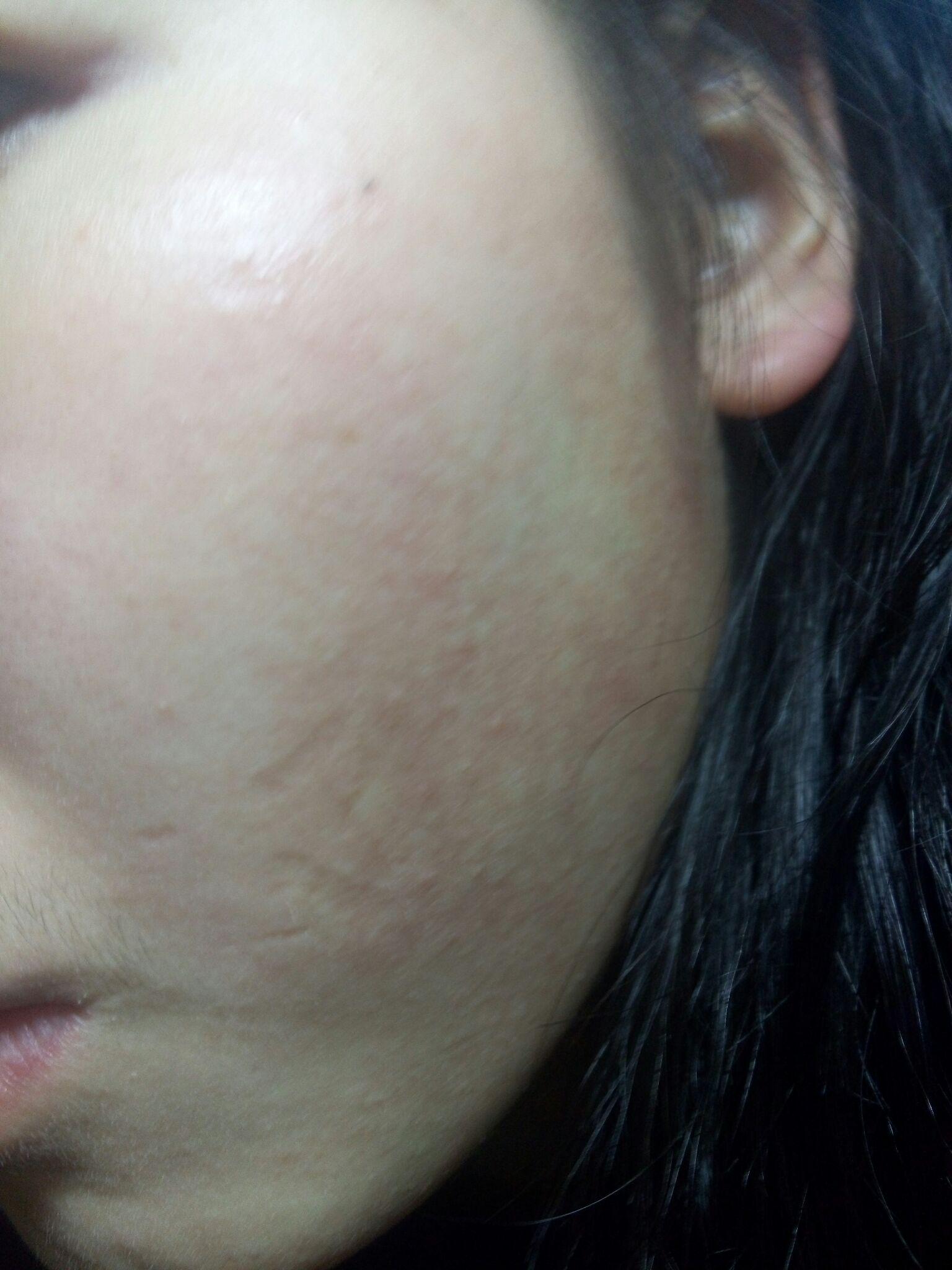 我的皮肤红一块白一块,而且会有一些小粒粒,但