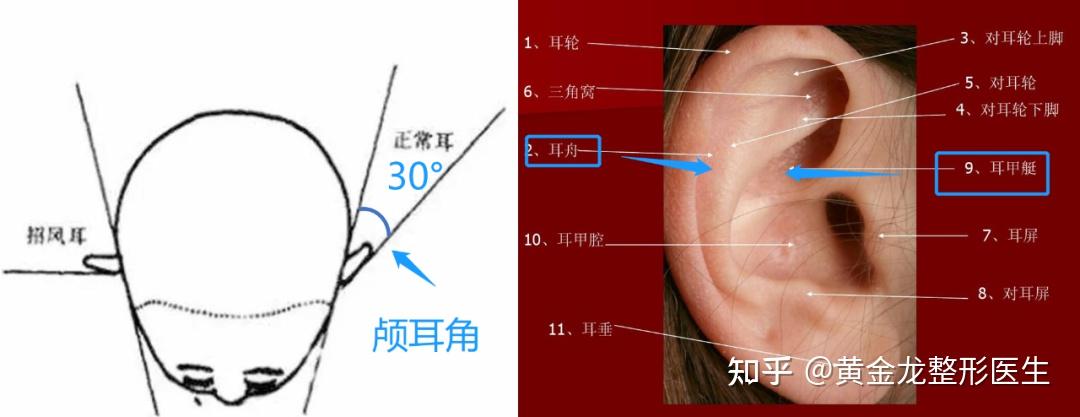 招風耳和貼面耳哪個好