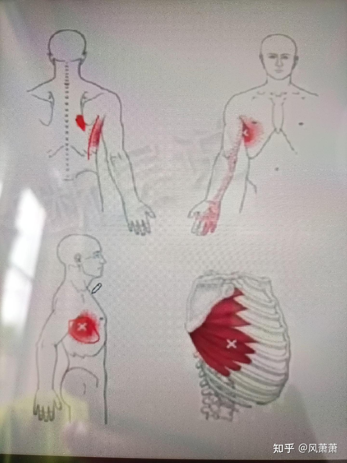 翼状肩胛骨必练的一块肌肉：前锯肌 - 知乎