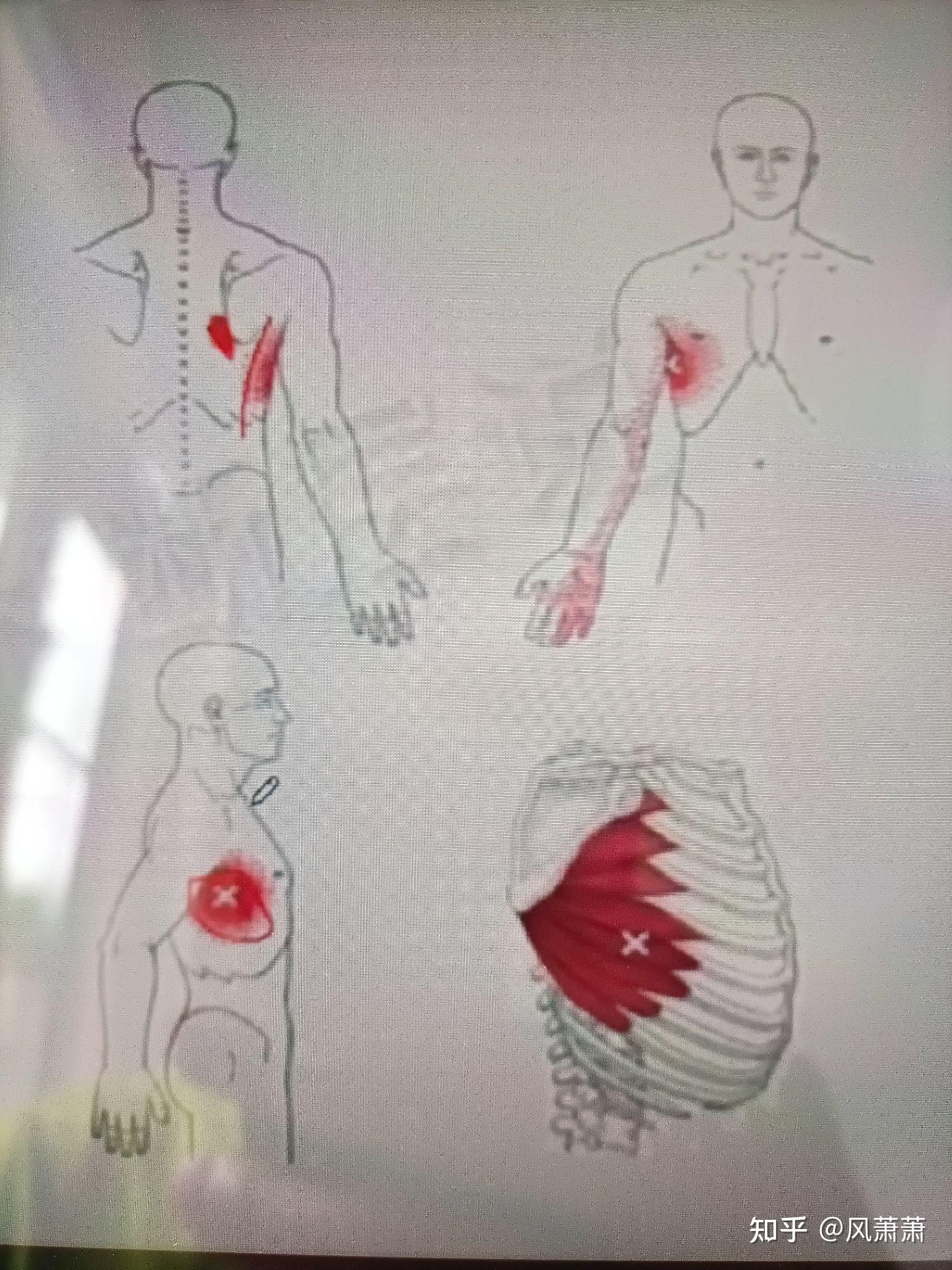 翼状肩胛骨必练的一块肌肉:前锯肌 - 知乎