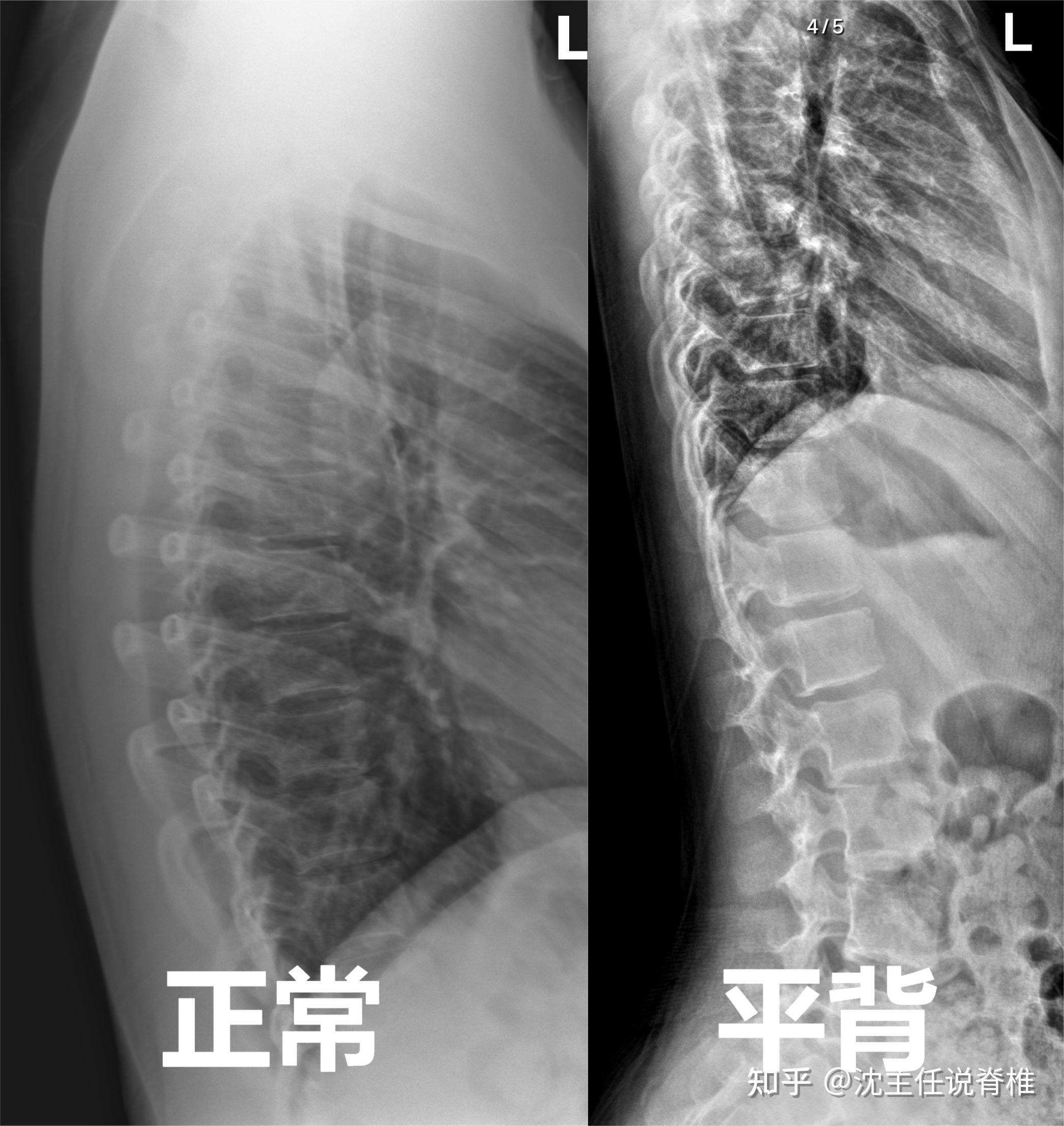 脊柱畸形矫正术（青少年脊柱侧弯，半椎体，后突驼背等） - 好大夫在线