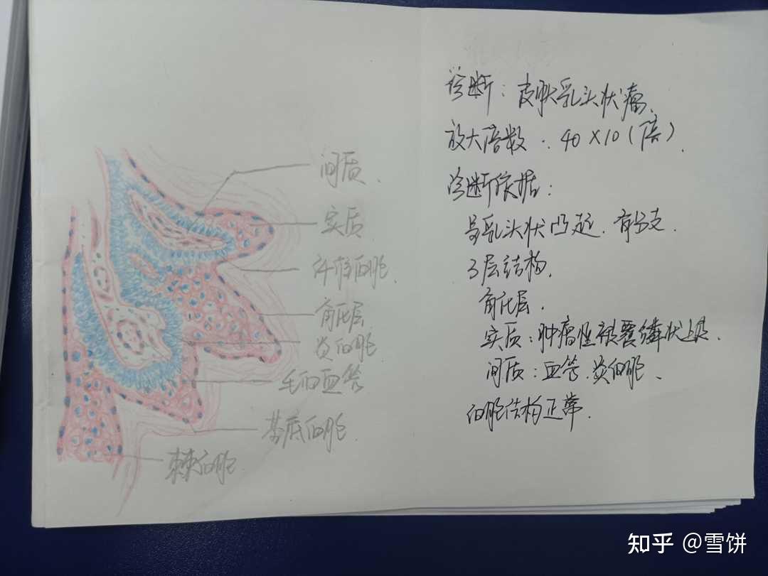平滑肌瘤红蓝绘图图片