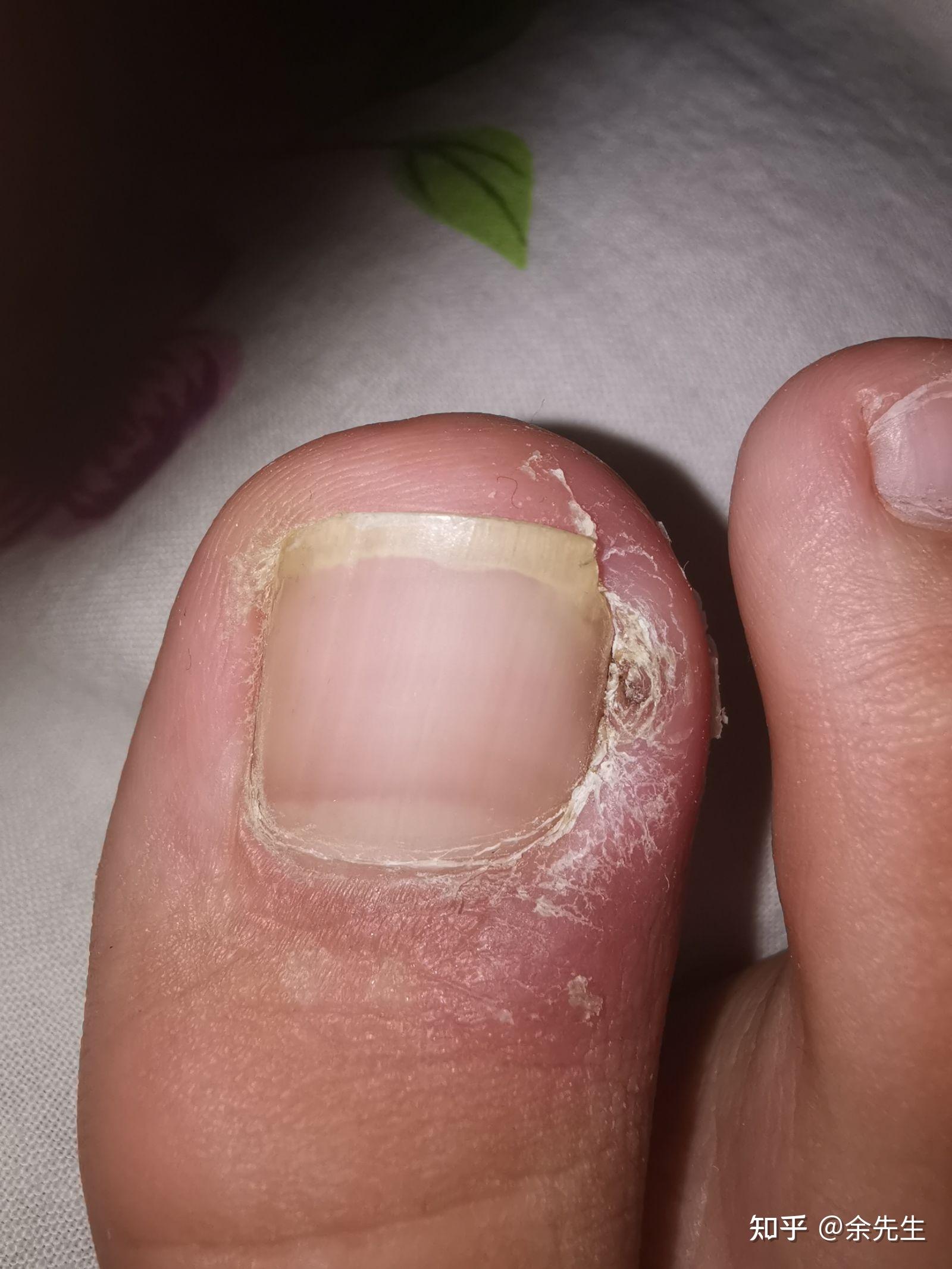 如果甲沟炎已经开始化脓了，自己应该怎么处理 - 知乎