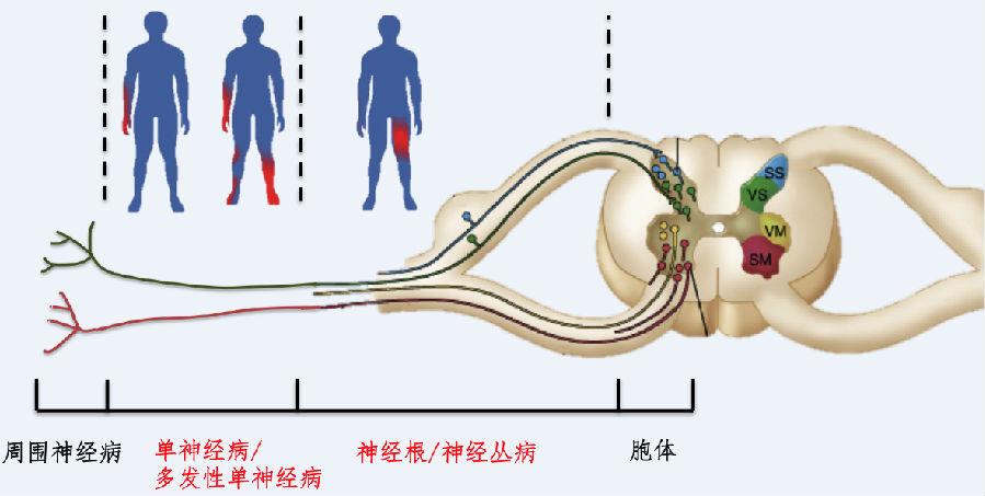掌握这些知识点诊断不典型周围神经病不再难