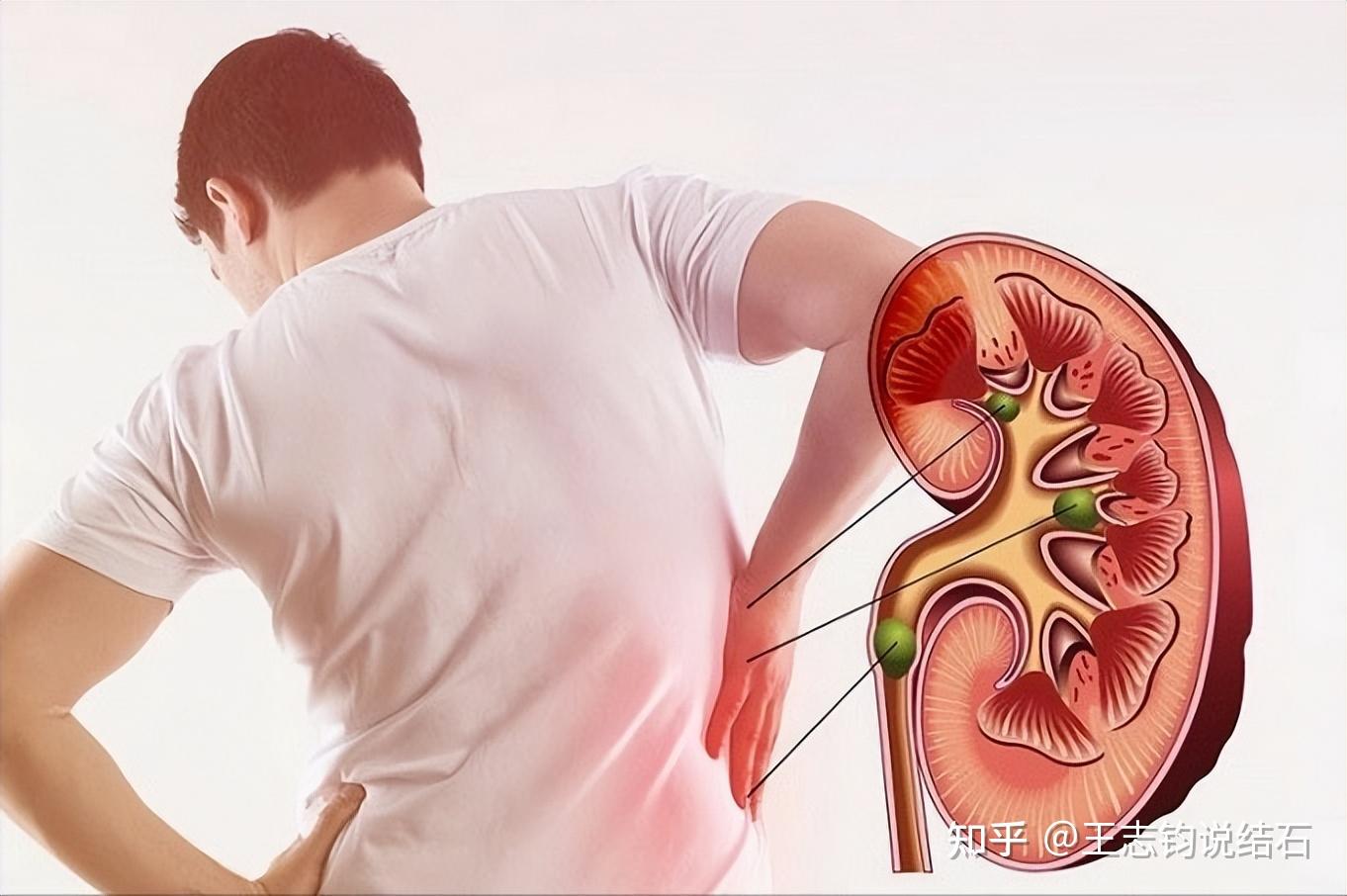 肾结晶是怎么回事 zhuanlan.zhihu.com