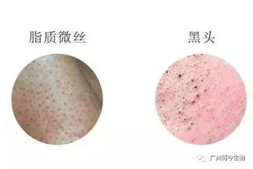 大数据请把这篇文章推给有“黑头”烦恼的人! - 知乎