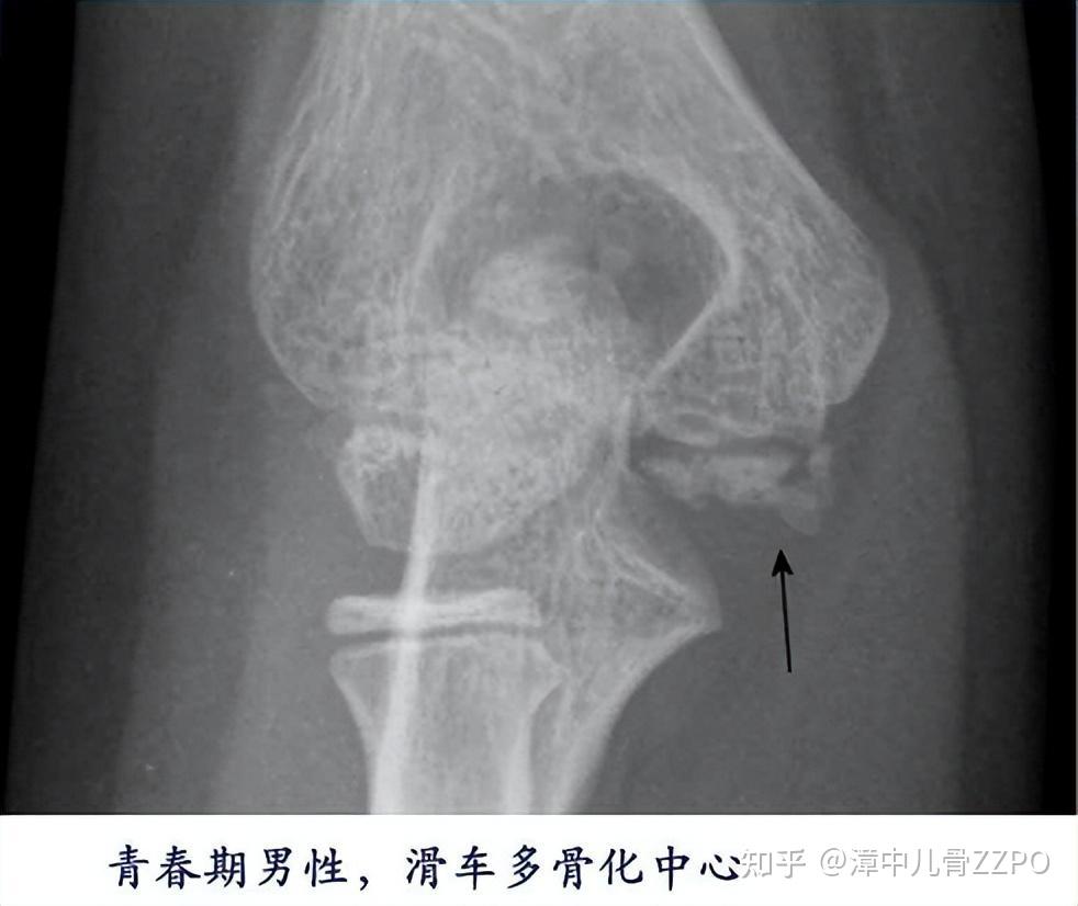 想读懂儿童肘关节X线，至少你该会这些！ - 知乎
