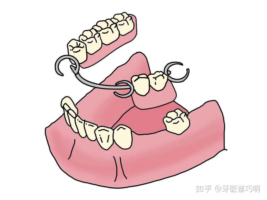 活动牙好还是固定牙好图片