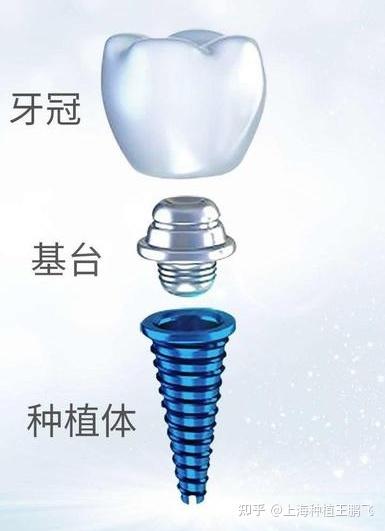 种植牙中的基台是什么? - 知乎