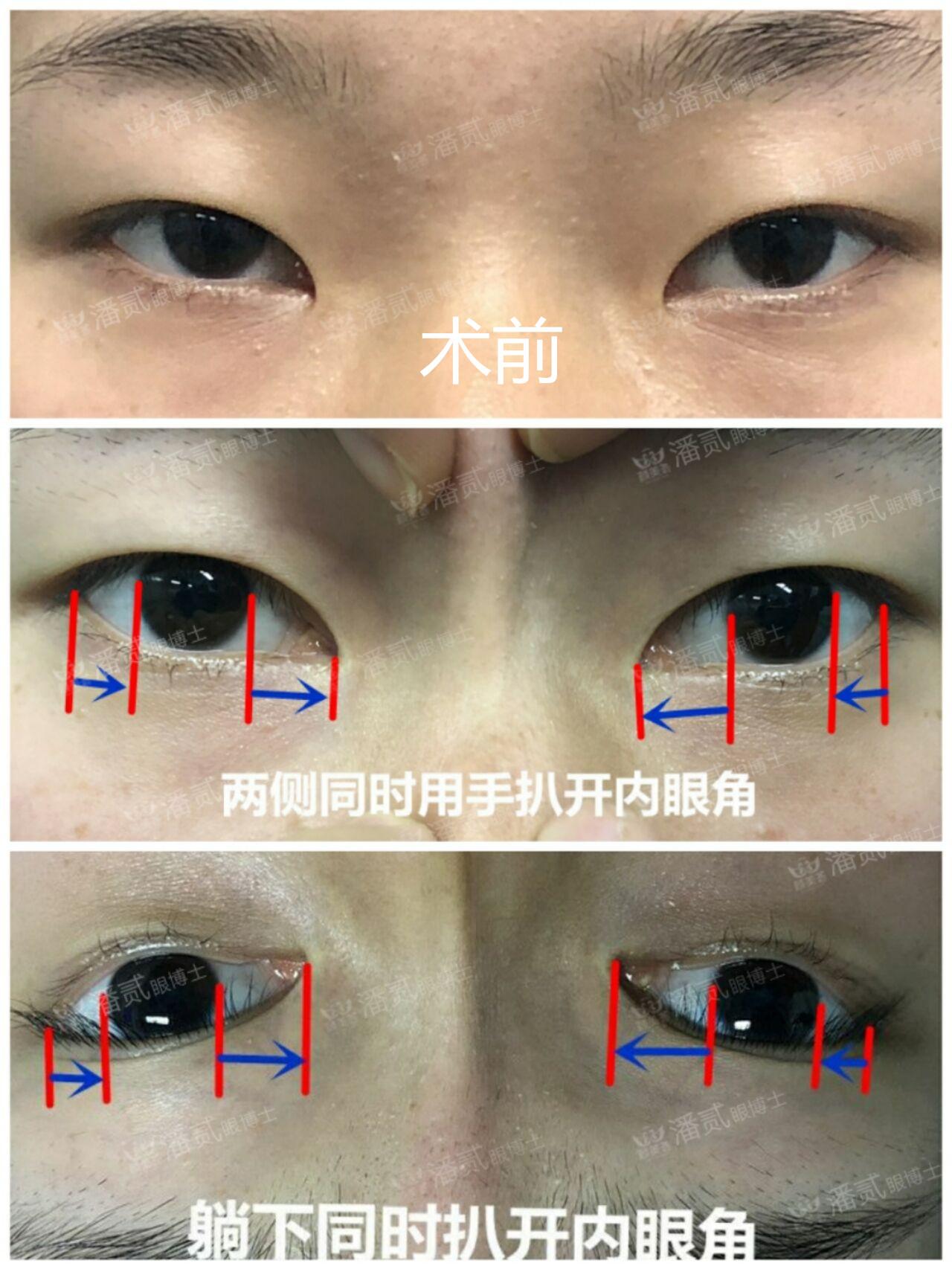开内眼角内眦赘皮矫正术成功了眼睛看起反而丑了还更奇怪