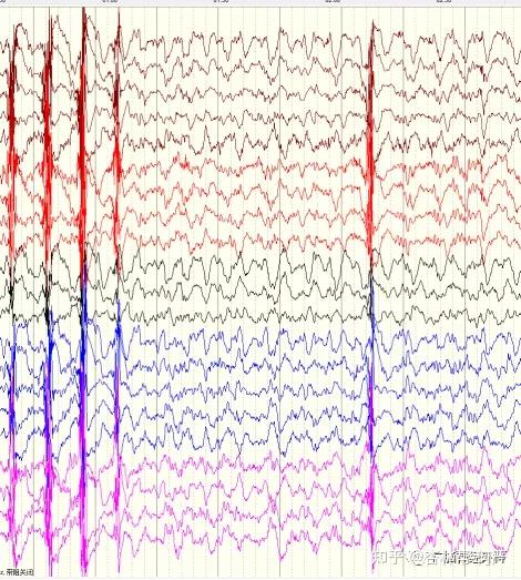 脑电图尖波和棘波图片图片