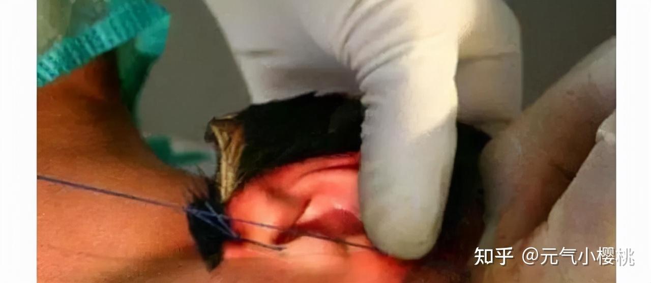 六例全球整容案例巴西狗头人的奇葩改造手术