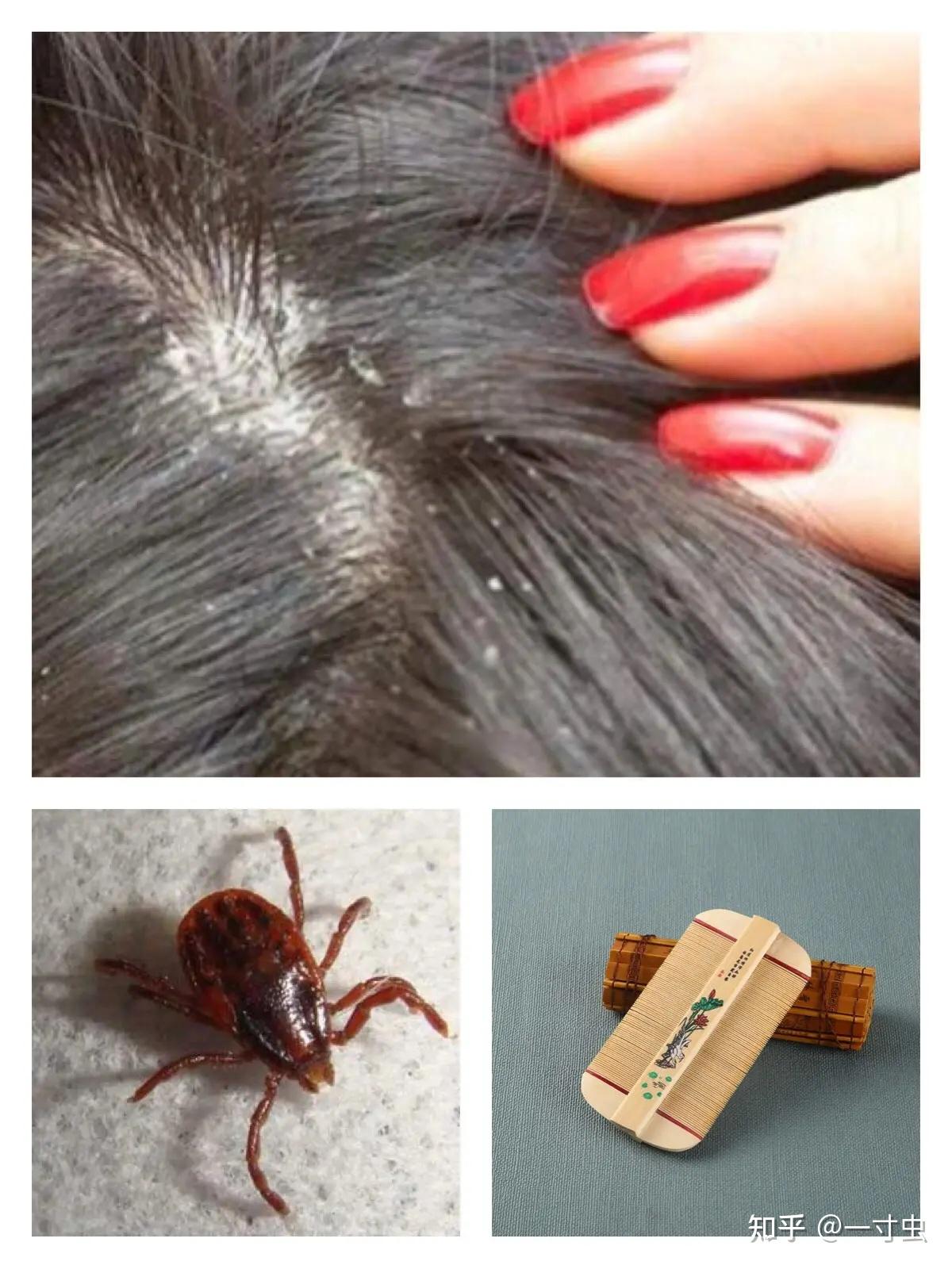 起来一看才发现被咬了一身包,只能起来抓虱子和跳蚤,但无论怎么抓,因
