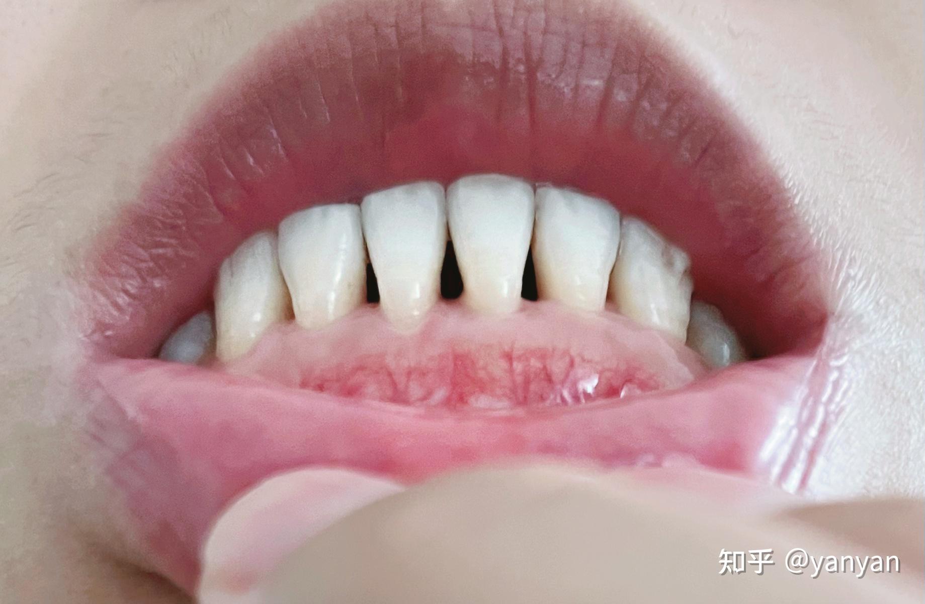 牙龈图片大全-牙龈高清图片下载-觅知网
