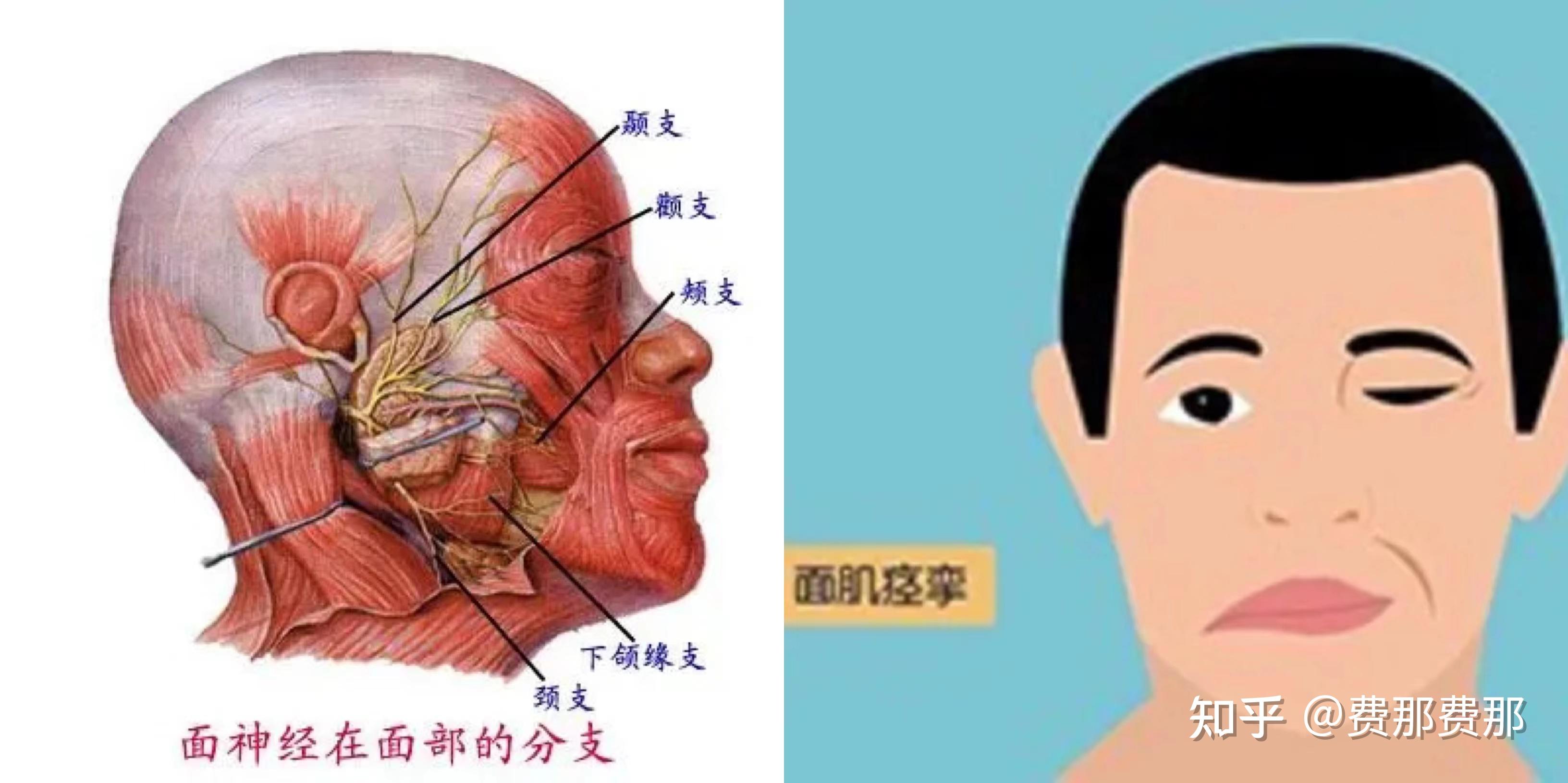 面肌痉挛常表现为一侧面部不自主抽搐,起病多从眼轮匝肌开始单侧眼皮