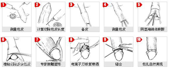 包茎手术拆线照片图片