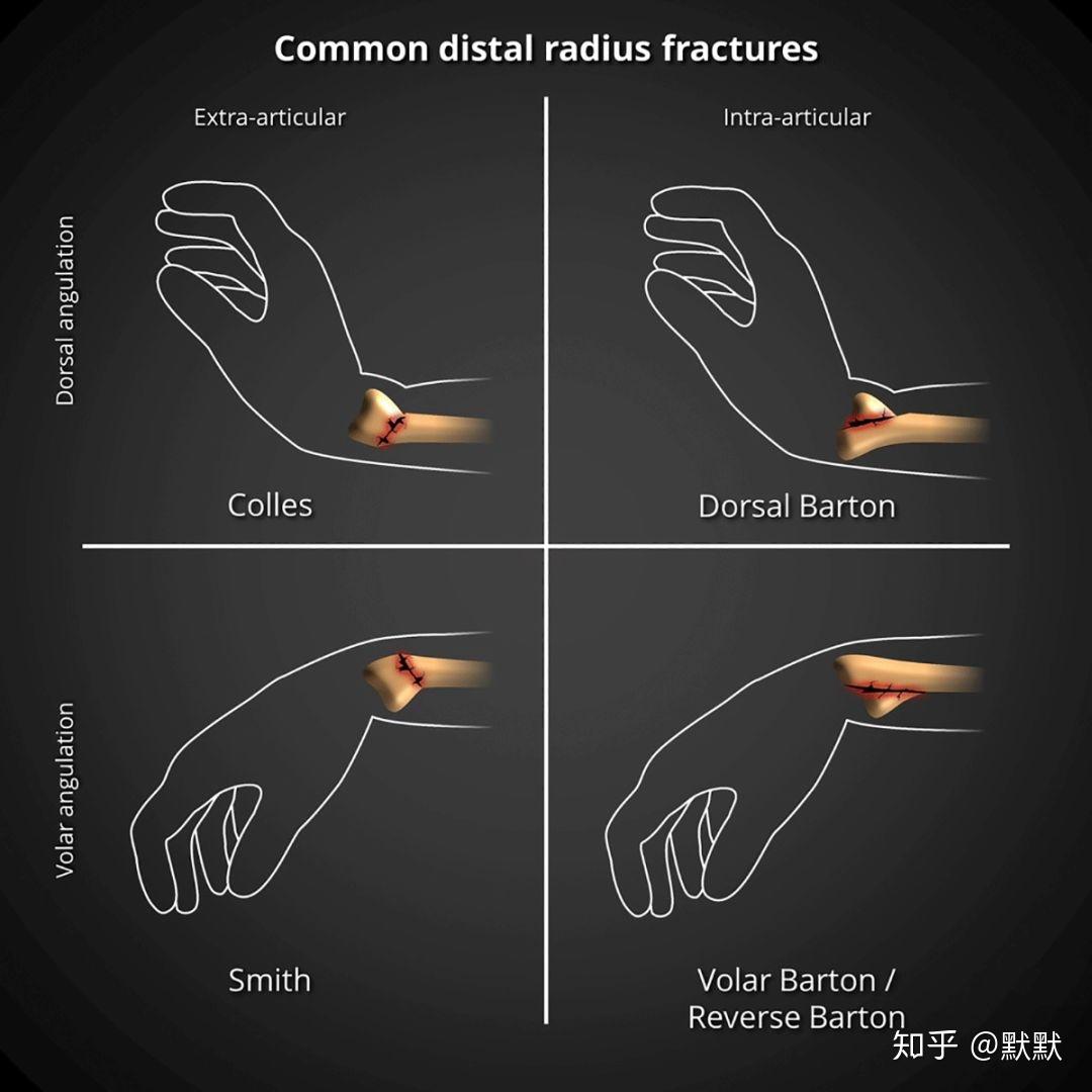 桡骨骨折手指活动图图片