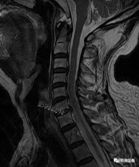 典型病例颈椎后纵韧带钙化mr