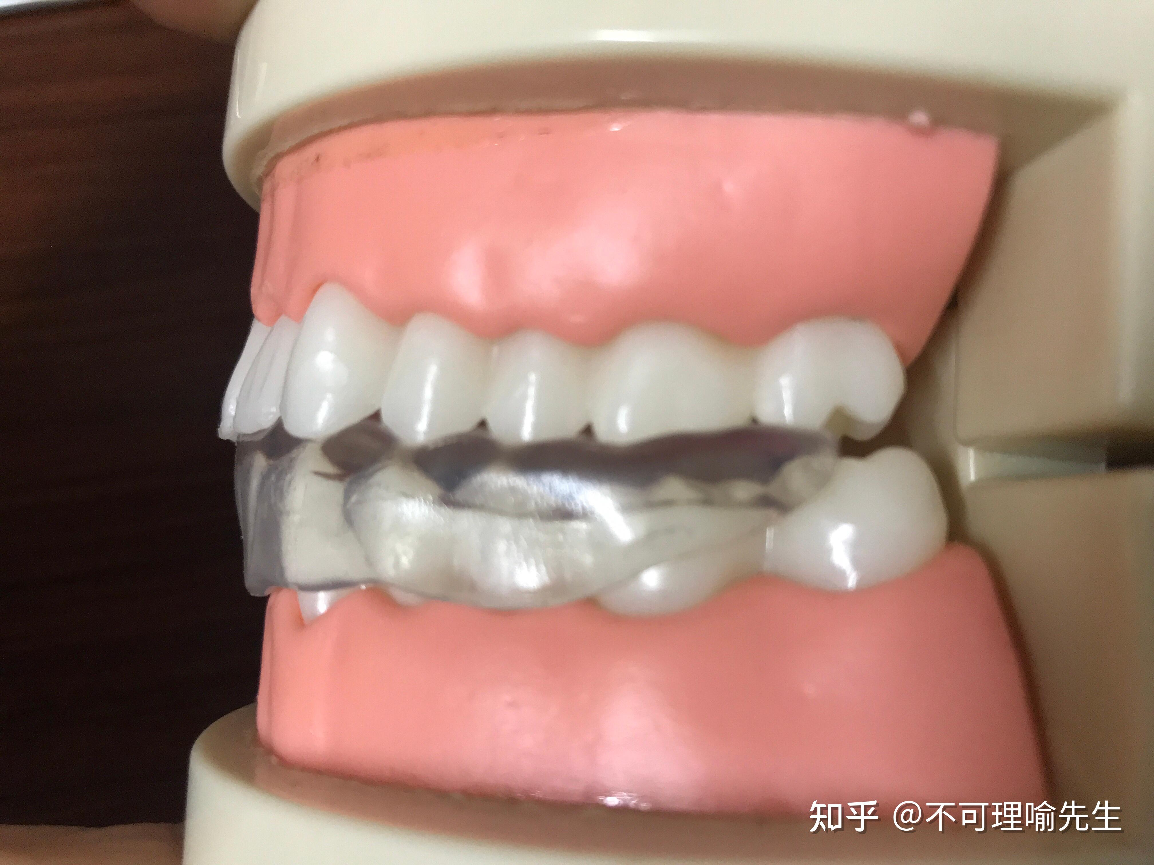 用了10年磨牙套的我告诉你应该怎么挑选牙套 - 知乎