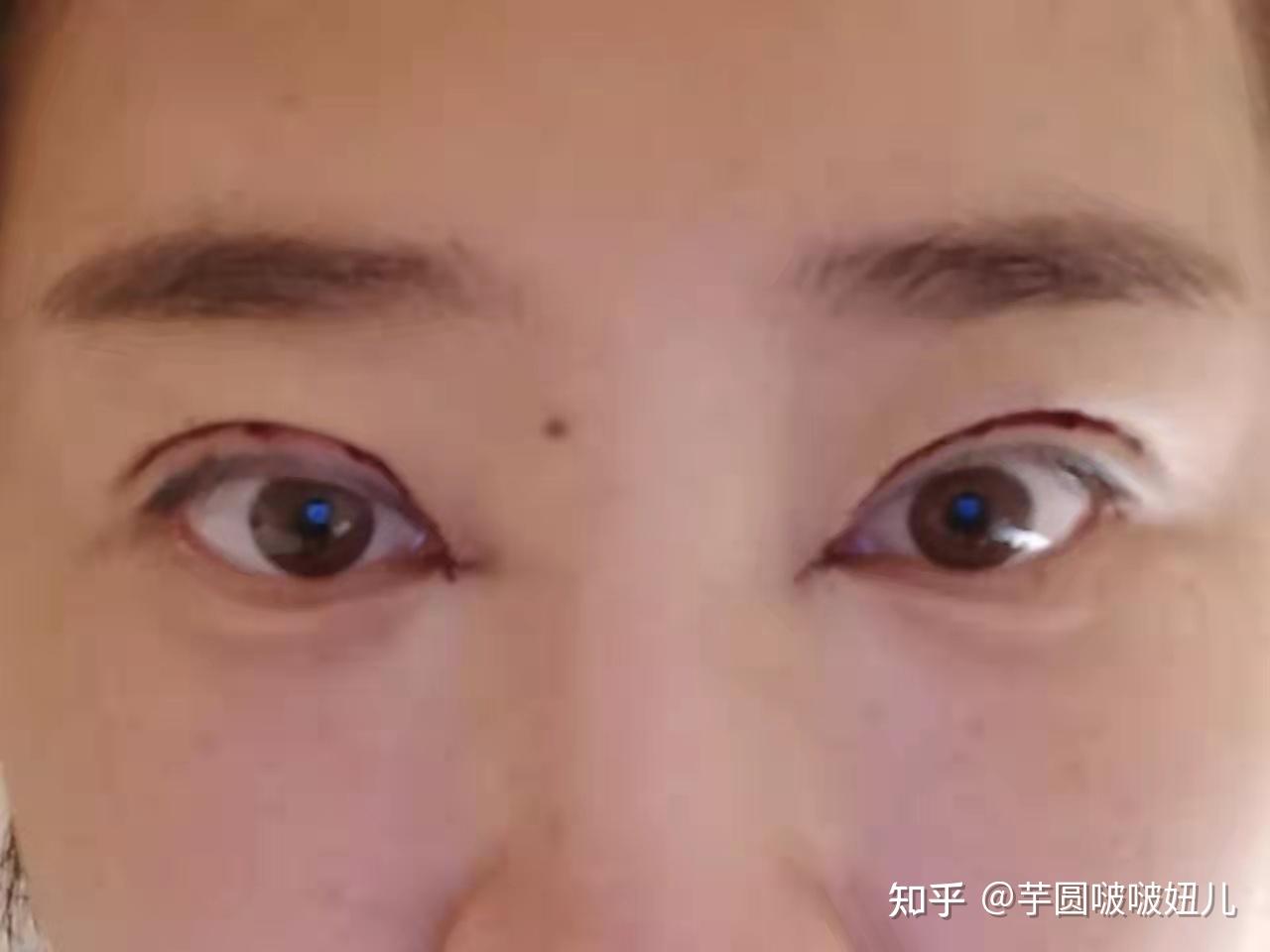 北京韩勋眼修复5个月，包眼角~难度太高了 - 知乎