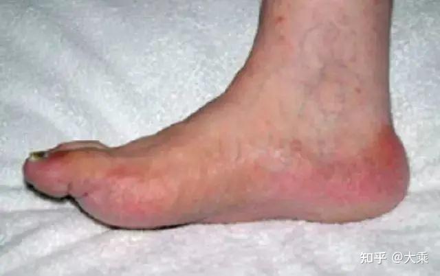 手足综合征handfootsyndromehfs及处理策略