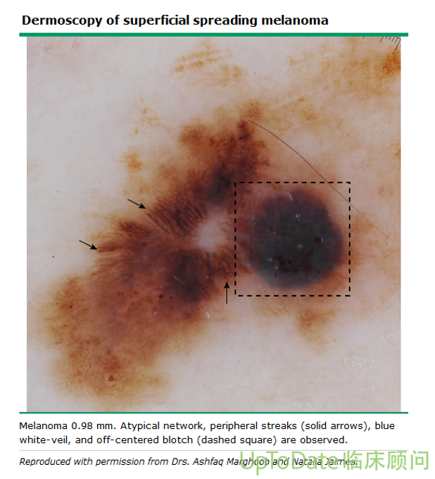 恶性黑色素瘤卫星灶图片